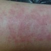 皮肤过敏的症状表现