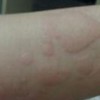 皮肤过敏患者能做好哪些防护措施