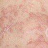 夏季过敏性疾病三大过敏源怎样的预防