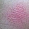 皮肤过敏有哪些护理的措施