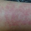皮肤过敏患者要如何保养