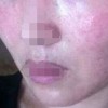 皮肤过敏患者要如何护理