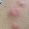 皮肤过敏后该怎样护理