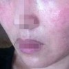 螨虫过敏症状