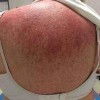 皮肌炎患者应认真护理