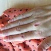 皮肌炎患者生活护理上需要留意啥