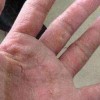 螨虫性皮炎是否传染