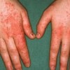 脂溢性皮炎的初期病情表现