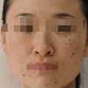 雀斑如何治疗疗效好