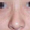 遗传性雀斑能去掉吗