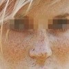 秋季预防雀斑知多少