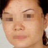 雀斑患者在往常的日子之中应该少吃什么