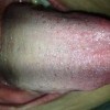 艾滋病引发的眼疾会经过泪水继续传染艾滋吗