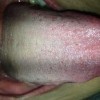 什么是艾滋病毒感染