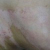 白癜风的发展演变过程是如何的