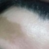白癜风的大危害