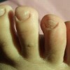 灰指甲患者如何对其进行治理