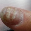 灰指甲的症状累及表现有哪些