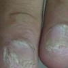 灰指甲的早期的症状有哪些明显的