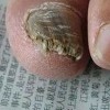 灰指甲对患者的常见危害