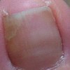 灰指甲给患者带来哪些作用
