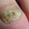 灰指甲的症状及治疗