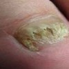 灰指甲对患者有哪些作用