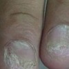 灰指甲的症状及原因