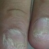 灰指甲的症状及原因