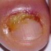 灰指甲的症状表现详细是哪些
