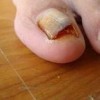 灰指甲都表现有啥