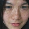 黄褐斑会给人带来什么伤害