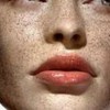 黄褐斑显著症状：常分布的均匀于脸部