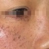 黄褐斑在夏季其症状有哪些