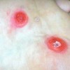 鸡眼与鞋子之间密切联系