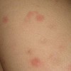 皮肤异痒常常看见的类型有哪些