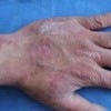 手足癣有哪些致病因素