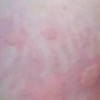 皮肤瘙痒症的护理措施有什么