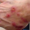 瘙痒病的种类及特点