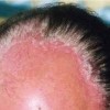 秋季怎样预防玫瑰糠疹的高发