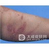 如何杜绝隐翅虫皮炎发生