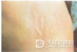 日光性荨麻疹是什么样的呢