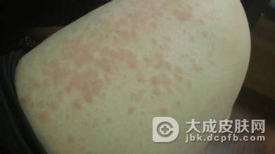 日光性荨麻疹是什么病