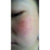 红血丝怎么治疗好