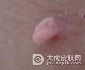 丝状疣应如何预防