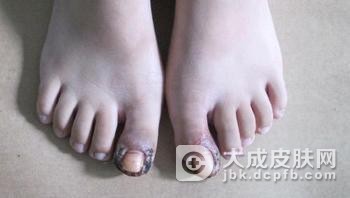 甲沟炎不治疗的危害