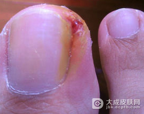 甲沟炎患者的注意事项
