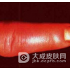 该如何鉴别诊断丹毒