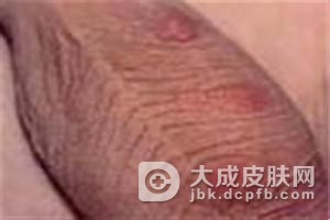 疥疮不当的治疗会引发哪些病症