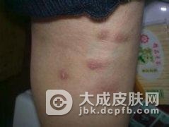 不同类型疥疮患者都有什么特点